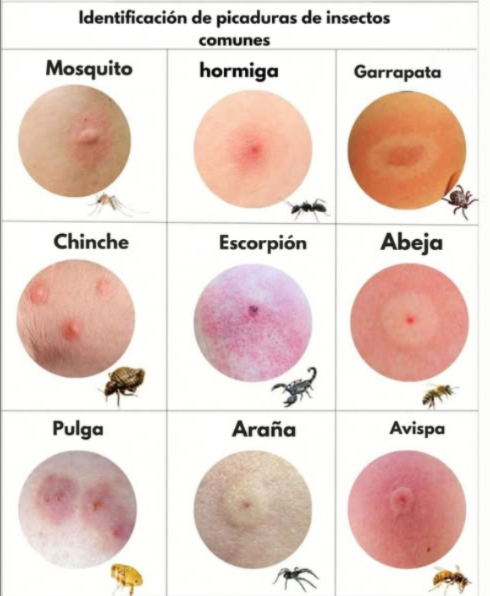 Identifica las picaduras más comunes de insectos con esta guía visual! 烈 Te has despertado alguna vez con una ronchita y te preguntas qué insecto fue el responsable? Esta imagen puede ayudarte a reconocer el tipo de picadura según su apariencia y el insecto que la causó. 烈 Mosquito: Picadura redonda y elevada, suele ser más activa por la noche. Hormiga: Enrojecida y con un centro irritado, a veces provoca ardor. Garrapata: Mancha con un anillo rojo alrededor; requiere atención médica inmediata! Chinche de cama: Varias picaduras pequeñas, a menudo dispuestas en línea. 廬 Alacrán: Área muy inflamada y rojiza, con dolor intenso. Abeja: Punción en el centro con hinchazón; puede dejar el aguijón. Pulga: Picaduras agrupadas que causan mucha picazón. Araña: Dos puntos centrales con enrojecimiento alrededor. Avispa: Inflamación notable, ardor y fuerte enrojecimiento. Consejo útil: Si experimentas hinchazón extrema, fiebre o dificultad para respirar, busca atención médica de inmediato. Algunas reacciones pueden ser graves! #PicadurasDeInsectos #SaludNatural #Chinches #InsectBites #NaturalHealth #BedBugs