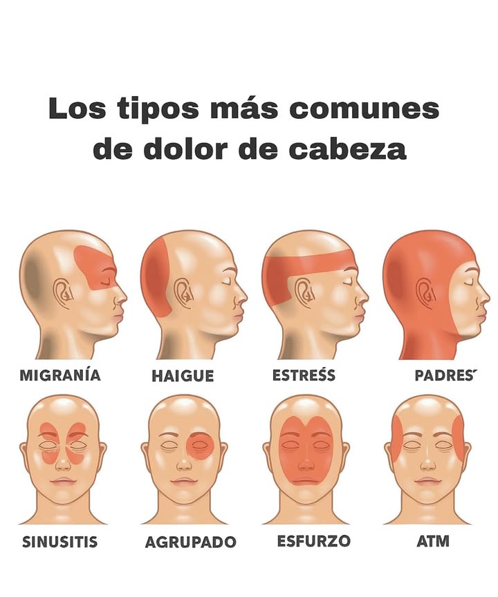勞 Tipos Comunes de Dolores de Cabeza y Dónde Afectan Migraña Dónde: Un lado, detrás del ojo/temporal Tipo: Pulsante, intenso Signos: Náuseas, luz/sonidos molestos Por Hipertensión Dónde: Parte posterior Tipo: Sordo, pulsante Nota: Empeora por la mañana Por Estrés Tensión Dónde: Frente, sienes, en banda Tipo: Presión constante Parental Dónde: Toda la cabeza Tipo: Sordo, por fatiga Causa: Estrés, poco sueño 蠟 Sinusal Dónde: Frente, ojos, mejillas Tipo: Presión Signos: Congestión, fiebre En Racimo Dónde: Detrás de un ojo Tipo: Punzante Signos: Lagrimeo, párpado caído Por Esfuerzo Dónde: Toda la cabeza Tipo: Repentino después de actividad TMJ Articulación Mandibular Dónde: Sienes, mandíbula, oídos Tipo: Dolor con clic o tensión Consulta a un médico si el dolor es: Repentino y fuerte Con visión borrosa o entumecimiento Persistente o empeora