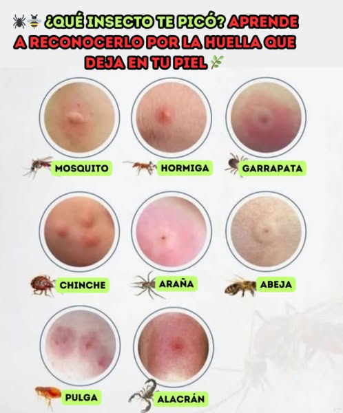 Qué insecto te picó? Aprende a reconocerlo por la huella que deja en tu piel Aunque muchas picaduras se ven parecidas, cada una tiene señales únicas que te ayudan a identificarlas y reaccionar rápido: Mosquito: Pequeña roncha que pica casi de inmediato. Hormiga: Pápula roja con ardor en el centro. Garrapata: Lesión redonda con un halo claro; suele verse el insecto adherido. Chinche: Varias picaduras alineadas o agrupadas, con leve inflamación. Araña: Zona roja con un centro más claro; algunas pueden ser peligrosas. Abeja: Punto visible, hinchazón y dolor local; puede quedar el aguijón. Pulga: Lesiones pequeñas que pican mucho, a menudo en grupos. Alacrán: Mancha rojiza que duele intensamente y puede generar adormecimiento. Recuerda: si aparecen fiebre, dificultad para respirar, hinchazón fuerte o dolor intenso, busca atención médica de inmediato. #Insectos #PicadurasDeInsectos #SaludYBienestar #ConsejosUtiles