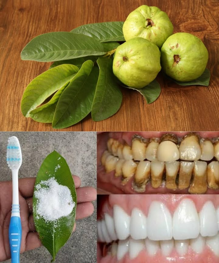 Hojas de guayaba: remedio natural para dientes y encías 醴 Las hojas de guayaba no solo son un recurso tradicional, también son un aliado antibacteriano, antiinflamatorio y refrescante para tu salud bucal. Aquí tienes 3 maneras sencillas y económicas de aprovecharlas: 1 Masticar hojas frescas Elige 23 hojas tiernas y limpias Mastícalas lentamente unos minutos Alivian el dolor, reducen la inflamación y refrescan el aliento 2 Enjuague bucal casero Hierve 57 hojas en 1 taza de agua por 10 min Cuela y deja enfriar Úsalo como enjuague 12 veces al día Disminuye placa, combate bacterias y calma las encías 3 Pasta con hojas y sal Machaca hojas frescas hasta obtener una pasta Añade una pizca de sal Aplica en el diente o encías por 5 min y enjuaga Antibacteriano, limpia y reduce sensibilidad Las hojas de guayaba no reemplazan al dentista, pero sí refuerzan tu cuidado diario junto al cepillado y la higiene regular.