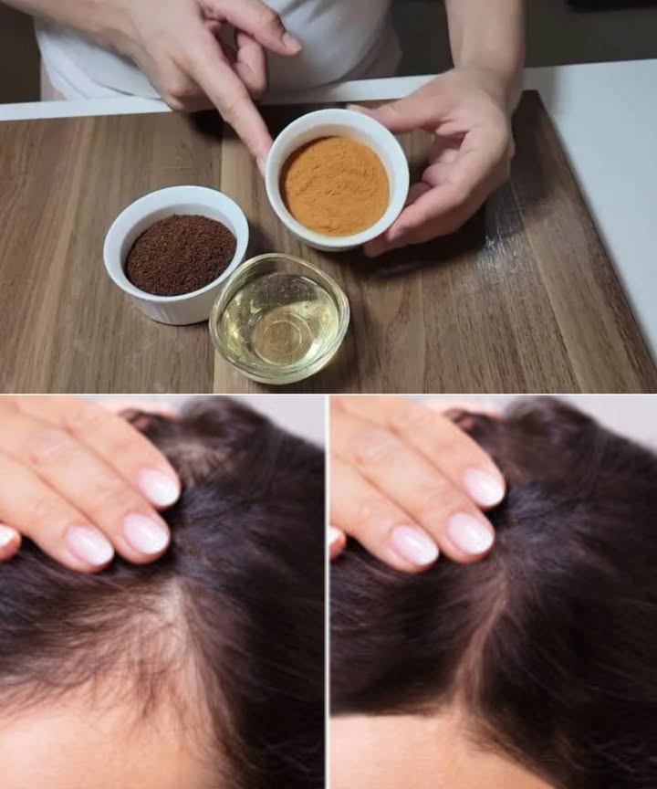 Detiene la caída del cabello y aumenta el crecimiento 10 veces en poco tiempo Un remedio casero que transforma tu melena. Con solo tres ingredientes naturales podrás frenar la caída y acelerar el crecimiento del cabello como nunca antes. Ingredientes clave: Canela molida, fortalece las raíces y estimula el crecimiento. Café molido, aporta cafeína que da fuerza y grosor al cabello. Champú común, para hidratar y unir la mezcla. Preparación fácil: Mezcla 3 cucharadas de café molido con 2 de canela. Añade un chorro de champú y mezcla bien hasta formar una mascarilla. Uso: Aplica en el cuero cabelludo y cabello, deja actuar 15 minutos y enjuaga con agua. Repite una vez a la semana. Resultados: Cabello más fuerte, menos caída y crecimiento rápido. Suave, brillante y lleno de vida. Despídete de productos químicos. La solución natural está en tu cocina.