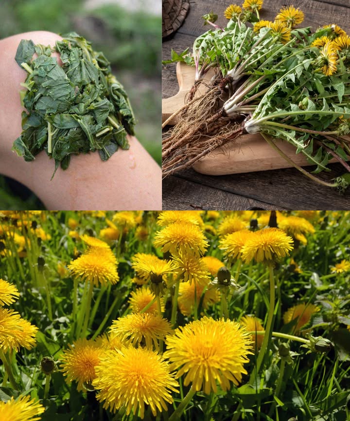 Diente de león: la joya oculta de la naturaleza con 30 beneficios increíbles El diente de león, a menudo considerado una simple maleza, es en realidad un superalimento lleno de nutrientes y propiedades medicinales. Desde raíces hasta flores, cada parte ofrece beneficios sorprendentes para la salud y el bienestar. Beneficios principales Rico en nutrientes: Vitaminas A, C, K, E y minerales esenciales como calcio, hierro, potasio y magnesio. Desintoxica el hígado: Favorece la producción de bilis y ayuda a eliminar toxinas. Mejora la digestión: Actúa como laxante suave y estimula el apetito. Favorece la función renal: Diurético natural que ayuda a eliminar exceso de agua, sal y toxinas. Regula el azúcar en sangre: Mejora la sensibilidad a la insulina y equilibra los niveles de glucosa. Propiedades antiinflamatorias: Reduce inflamación, alivia artritis y dolor muscular. Favorece la pérdida de peso: Ayuda a eliminar líquidos retenidos y mejora el metabolismo. Salud de la piel: Combate acné, eccema y signos de envejecimiento. Refuerza el sistema inmunitario: Antioxidantes que protegen frente a infecciones. Reduce el colesterol: Mejora el perfil lipídico y protege el corazón. Combate el cáncer: Potencial anticancerígeno, especialmente en leucemia y melanoma. Reduce la presión arterial: Mantiene equilibrio de líquidos y salud cardiovascular. Salud ósea: Rica en calcio y vitamina K para huesos fuertes. Envejecimiento saludable de la piel: Mejora elasticidad y reduce arrugas. Estimula el crecimiento del cabello: Nutre folículos y fortalece el cuero cabelludo. Combate infecciones: Propiedades antibacterianas y antifúngicas naturales. Salud ocular: Vitamina A y luteína para proteger la visión. Función de la vesícula biliar: Favorece la producción de bilis y previene cálculos. Equilibra hormonas: Ayuda en la regulación hormonal y desintoxicación. Salud del corazón: Reduce colesterol y presión arterial, protege el sistema cardiovascular. Prebiótico natural: Contiene inulina para mejorar la flora intestinal. Función cerebral: Antioxidantes que apoyan memoria y cognición. Alivia retención de líquidos: Reduce hinchazón y edema. Mejora el estado de ánimo: Magnesio y vitaminas B para equilibrio emocional. Función hepática saludable: Desintoxica y mejora procesamiento de nutrientes. Alivia el estreñimiento: Fibra y propiedades laxantes suaves. Previene anemia: Hierro y vitamina C que favorecen la producción de glóbulos rojos. Salud articular: Reduce dolor y rigidez en articulaciones. Salud respiratoria: Anti-inflamatorio y antioxidante que alivia síntomas respiratorios. Aumenta la energía: Mejora vitalidad y combate fatiga. Cómo incorporarlo Té de diente de león: Infusión de hojas o raíces para desintoxicar y fortalecer el cuerpo. Ensaladas y batidos: Hojas frescas crujientes que aportan nutrientes esenciales. Platos cocinados: Salteados, sopas o guisos para añadir sabor y beneficios. Suplementos: Extractos o cápsulas concentradas para un aporte diario. Cataplasmas y mascarillas: Uso tópico para piel y cuero cabelludo saludable. El diente de león demuestra que las plantas más humildes pueden ofrecer beneficios extraordinarios para el cuerpo y la mente. Incorporarlo a tu dieta y estilo de vida es una forma natural de mejorar la salud, proteger el corazón, nutrir la piel y aumentar la energía.