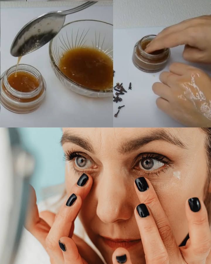 Gel de clavo para una piel lisa: ayuda a alisar arrugas finas y rejuvenecer la piel Beneficios del clavo Actúa como un botox natural. Ayuda a eliminar arrugas del rostro y cuello sin cirugía ni químicos. Exfolia, suaviza y mejora la firmeza de la piel. Exfoliante natural de clavo Triturar un puñado de clavo hasta obtener un polvo fino. Añadir 3 cucharadas de polvo a agua en un cazo. Hervir a fuego medio durante 10 minutos, removiendo constantemente. Colar con una gasa o colador fino. Mezclar 3 cucharadas del residuo con: 2 cucharadas de azúcar, 2 cucharadas de aceite de oliva o aceite de coco/almendra. Aplicar en rostro y cuello, masajear 2 minutos y enjuagar con agua. Usar 2 veces por semana. Gel antiarrugas de clavo y linaza Hervir 2 cucharadas de semillas de lino en 1 vaso de agua durante 15 minutos hasta obtener una mezcla gelatinosa. Colar con un paño fino para extraer el gel. Añadir: 4 cucharadas del extracto de clavo hervido, 1 cucharada de aceite de coco, 1 cucharada de gel de aloe vera. Mezclar bien hasta lograr una textura homogénea. Masajear en rostro y cuello unos minutos y dejar actuar 30 minutos. Guardar en un frasco de vidrio en la nevera, máximo 7 días. Aplicar cada noche antes de dormir para un efecto rejuvenecedor visible.