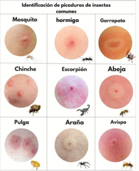 Identifica las picaduras más comunes de insectos con esta guía visual! 烈 Te has despertado alguna vez con una ronchita y te preguntas qué insecto fue el responsable? Esta imagen puede ayudarte a reconocer el tipo de picadura según su apariencia y el insecto que la causó. 烈 Mosquito: Picadura redonda y elevada, suele ser más activa por la noche. Hormiga: Enrojecida y con un centro irritado, a veces provoca ardor. Garrapata: Mancha con un anillo rojo alrededor; requiere atención médica inmediata! Chinche de cama: Varias picaduras pequeñas, a menudo dispuestas en línea. 廬 Alacrán: Área muy inflamada y rojiza, con dolor intenso. Abeja: Punción en el centro con hinchazón; puede dejar el aguijón. Pulga: Picaduras agrupadas que causan mucha picazón. Araña: Dos puntos centrales con enrojecimiento alrededor. Avispa: Inflamación notable, ardor y fuerte enrojecimiento. Consejo útil: Si experimentas hinchazón extrema, fiebre o dificultad para respirar, busca atención médica de inmediato. Algunas reacciones pueden ser graves! #PicadurasDeInsectos #SaludNatural #Chinches