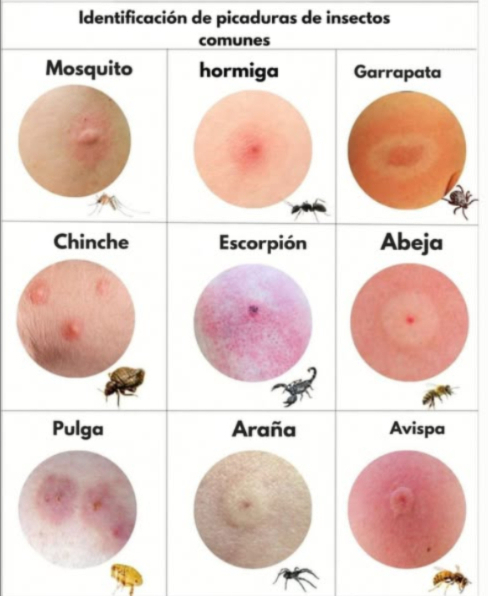 Identifica las picaduras más comunes de insectos con esta guía visual! 烈 Te has despertado alguna vez con una ronchita y te preguntas qué insecto fue el responsable? Esta imagen puede ayudarte a reconocer el tipo de picadura según su apariencia y el insecto que la causó. 烈 Mosquito: Picadura redonda y elevada, suele ser más activa por la noche. Hormiga: Enrojecida y con un centro irritado, a veces provoca ardor. Garrapata: Mancha con un anillo rojo alrededor; requiere atención médica inmediata! Chinche de cama: Varias picaduras pequeñas, a menudo dispuestas en línea. 廬 Alacrán: Área muy inflamada y rojiza, con dolor intenso. Abeja: Punción en el centro con hinchazón; puede dejar el aguijón. Pulga: Picaduras agrupadas que causan mucha picazón. Araña: Dos puntos centrales con enrojecimiento alrededor. Avispa: Inflamación notable, ardor y fuerte enrojecimiento. Consejo útil: Si experimentas hinchazón extrema, fiebre o dificultad para respirar, busca atención médica de inmediato. Algunas reacciones pueden ser graves! #PicadurasDeInsectos #SaludNatural #Chinches #InsectBites #NaturalHealth #BedBugs