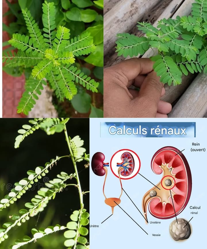 Pierre Briseuse Phyllanthus niruri : lherbe miracle aux multiples usages 
Phyllanthus niruri, souvent appelée  Pierre Briseuse , est une plante reconnue depuis des siècles dans les médecines traditionnelles. Elle soutient les reins, le foie, la peau et bien dautres fonctions essentielles. Voici ses bienfaits principaux et des façons simples de lutiliser au quotidien.
 25 bienfaits essentiels
 Dissout naturellement les calculs rénaux
 Favorise la détoxification et apaise le foie
 Réduit le risque de calculs biliaires
 Soulage ballonnements et constipation
 Renforce limmunité
 Aide à réguler la glycémie
 Apaise douleurs articulaires et musculaires
 Diminue lacide urique prévention de la goutte
 Améliore létat de la peau acné, eczéma
 Soulage asthme et bronchite
 Protège le cœur et favorise la circulation
 Aide contre lhépatite B et autres virus
 Combat certaines infections bactériennes
 Soutient la tension artérielle
 Accélère le métabolisme gestion du poids
 Apaise les douleurs menstruelles
 Favorise un meilleur sommeil
 Redonne énergie et vitalité
 Aide à éliminer les toxines
 Réduit le stress et lanxiété
 Accélère la cicatrisation
 Lutte contre les infections fongiques
 Protège la vésicule biliaire
 Soulage certaines douleurs chroniques
 Protège la vision grâce à ses antioxydants
 Comment lutiliser facilement à la maison
1 Infusion simple
Ingrédients :
 1 c. à café de feuilles séchées 
 1 tasse deau 
Préparation : faire bouillir leau, ajouter les feuilles, laisser frémir 10 minutes, filtrer et boire tiède.
2 Poudre à consommer
Ingrédients :
 Feuilles séchées réduites en poudre 
Préparation : mélanger  c. à café dans de leau ou du jus et boire directement.
3 Application cutanée
Ingrédients :
 Feuilles fraîches 
Préparation : écraser en pâte et appliquer 15 à 20 minutes sur plaies, acné ou zones irritées, puis rincer.
4 Huile infusée pour massage
Ingrédients :
 1 tasse de feuilles fraîches 
 1 tasse dhuile de coco ou dolive 㮝
Préparation : chauffer doucement 20 minutes, filtrer et masser les zones douloureuses.
5 Capsules maison
Ingrédients :
 Poudre de Phyllanthus 
 Gélules vides 
Préparation : remplir les gélules et conserver dans un pot hermétique.
6 Décoction intensive
Ingrédients :
 2 c. à soupe de feuilles séchées 
 2 tasses deau 
Préparation : faire réduire de moitié à feu moyen, filtrer et boire 2 c. à soupe deux fois par jour.
 Conseils pratiques
 Commencer toujours par de petites doses
 Utiliser des feuilles de qualité, fraîches ou séchées
 Demander un avis médical en cas de grossesse, allaitement ou traitement en cours
La Pierre Briseuse est une alliée naturelle précieuse, facile à intégrer au quotidien pour soutenir la santé des reins, du foie et bien plus encore.
#santenaturelle 
#plantesmedicinales 
#fblifestyle