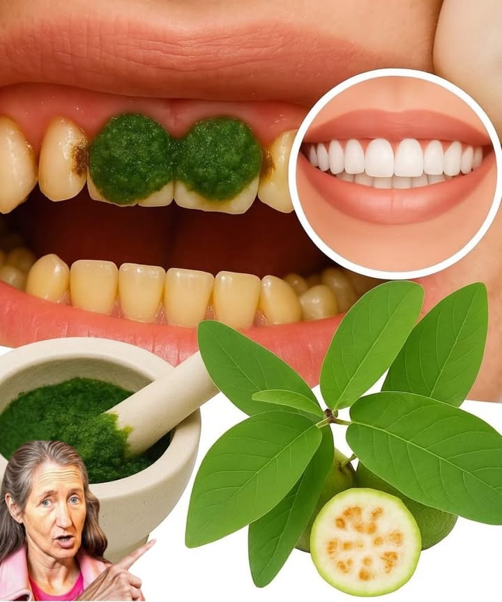 Sourire éclatant naturel 
Ingrédients 
 Feuilles de goyave fraîches
 Un peu deau tiède
襁 Mortier ou mixeur
Étapes 
1 Laver bien les feuilles de goyave et les écraser dans un mortier avec un peu deau pour obtenir une pâte verte.
2 Appliquer cette pâte directement sur les dents et les gencives.
3 Laisser agir 5 à 10 minutes pour permettre aux propriétés antibactériennes dagir.
4 Rincer doucement la bouche à leau tiède.
5 Répéter 2 à 3 fois par semaine pour des dents plus propres et une haleine fraîche.
Cette méthode naturelle aide à éliminer la plaque, rafraîchit lhaleine et redonne de léclat au sourire.