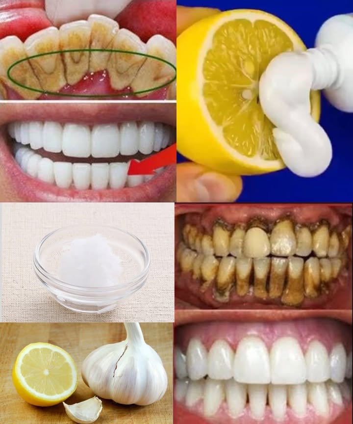 Astuce maison pour dents plus blanches 
Ingrédients simples à préparer :
Citron 
Ail 龍
Huile de coco 便
Étapes faciles à suivre :
1 Presse un peu de jus de citron et mélange-le avec une petite quantité dhuile de coco.
2 Ajoute une gousse dail écrasée dans le mélange.
3 Utilise une brosse douce pour appliquer la préparation sur les dents pendant quelques secondes.
4 Rince bien la bouche avec de leau claire.
5 Répète seulement une ou deux fois par semaine.
Ce mélange naturel aide à réduire les taches et donner un éclat plus lumineux aux dents.