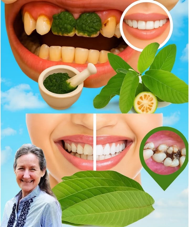 Feuilles de goyave : le secret naturel contre les caries 
Les feuilles de goyave sont une véritable bénédiction de la nature. Grâce à leurs propriétés antibactériennes et anti-inflammatoires, elles peuvent aider à réduire les caries, apaiser les gencives sensibles et rafraîchir lhaleine naturellement.
 Ingrédients
5 à 7 feuilles de goyave fraîches 
2 tasses deau 
1 cuillère à café dhuile de coco 便
Une pincée de sel marin 蓼
醴 Étapes simples
1 Bain de bouche naturel
Faites bouillir les feuilles de goyave dans leau pendant 10 minutes. Laissez refroidir, filtrez, puis utilisez comme bain de bouche deux fois par jour.
2 Feuilles à mâcher
Mâchez 2 à 3 feuilles fraîches lentement pendant 5 à 10 minutes, puis rincez votre bouche à leau claire.
3 Pâte apaisante
Séchez quelques feuilles, réduisez-les en poudre, mélangez avec lhuile de coco et appliquez la pâte sur les zones sensibles pendant 5 minutes avant de rincer.
4 Routine quotidienne
Rincez matin et soir, mâchez après le déjeuner et appliquez la pâte dès que vos dents deviennent sensibles.
 En adoptant ces gestes simples, vous renforcez vos dents naturellement tout en profitant des bienfaits dune plante utilisée depuis des générations.
#soindentaire