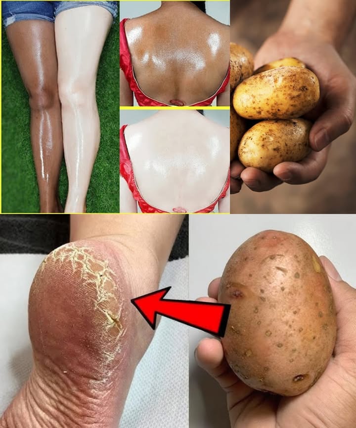 Beauté Naturelle : 13 Utilisations du Pomme de Terre 
Les pommes de terre ne servent pas quen cuisine. Grâce à leurs vitamines C, B et leurs enzymes naturelles, elles soignent la peau, les cheveux et les yeux. Voici comment les utiliser simplement à la maison.
凜 1 Atténuer les cernes
Les enzymes du jus de pomme de terre éclaircissent le contour des yeux et réduisent les poches.
Utiliser : appliquer des tranches froides sur les paupières 15 minutes chaque jour.
凜 2 Estomper les cicatrices dacné
Le jus agit comme un éclaircissant doux.
Utiliser : tamponner le jus sur les marques, laisser agir 15 minutes, puis rincer.
凜 3 Adoucir les talons
Leur amidon hydrate et exfolie.
Utiliser : mélanger purée de pomme de terre et jus de citron, appliquer en masque et garder toute la nuit.
凜 4 Apaiser les yeux gonflés
Utiliser : râper une pomme de terre froide, lenvelopper dans une gaze et poser sous les yeux 10 minutes.
凜 5 Raviver léclat du visage
Utiliser : mélanger jus de pomme de terre et miel, appliquer 20 minutes pour un teint lumineux.
凜 6 Lutter contre le vieillissement
Les antioxydants raffermissent et revitalisent la peau.
Utiliser : mélanger pomme de terre crue mixée et yaourt nature, deux fois par semaine.
凜 7 Nourrir les cheveux
Leur jus renforce et hydrate les fibres capillaires.
Utiliser : combiner jus de pomme de terre et gel daloe vera, laisser poser 30 minutes.
凜 8 Favoriser la pousse
Utiliser : mélanger jus de pomme de terre, miel et jaune dœuf, appliquer en masque capillaire une fois par semaine.
凜 9 Réguler la peau grasse
Utiliser : appliquer le jus pur comme tonique, ou ajouter quelques gouttes de citron.
凜  Exfolier en douceur
Utiliser : mélanger purée de pomme de terre, farine de riz et lait, masser doucement.
凜 11 Calmer les coups de soleil
Le jus froid soulage et éclaircit la peau brûlée.
Utiliser : appliquer 20 minutes, puis rincer à leau fraîche.
凜 12 Éclaircir les lèvres
Utiliser : appliquer du jus cru sur les lèvres avant le coucher.
凜 13 Raffermir la peau
Utiliser : battre du jus de pomme de terre avec un blanc dœuf, appliquer et rincer après séchage.
 Conseils pratiques
Toujours utiliser des pommes de terre fraîches.
Faire un test sur une petite zone avant application.
Éviter les plaies ou les boutons ouverts.
Répéter deux à trois fois par semaine pour des résultats visibles.
 Les pommes de terre sont une solution naturelle, économique et efficace pour prendre soin de soi sans produits chimiques.