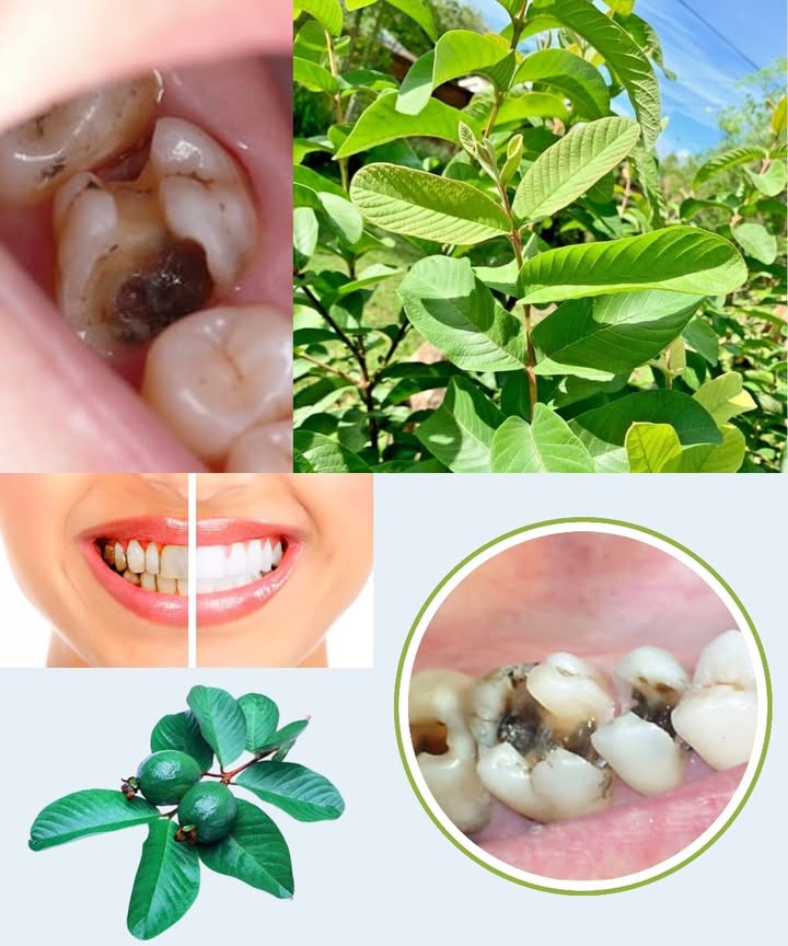 3 Remèdes Naturels avec les Feuilles de Goyave pour un Sourire Sain 
 Les feuilles de goyave sont un secret ancien de la nature pour garder les dents fortes et les gencives saines. Riches en tanins, flavonoïdes et antioxydants, elles aident à combattre les bactéries, apaisent les inflammations et rafraîchissent naturellement la bouche.
 Ingrédients 
 Feuilles de goyave fraîches 
 Eau chaude 
 Sel naturel optionnel 蓼
 1 Mâcher les Feuilles Fraîches
Prenez 2 à 3 feuilles propres et mâchez-les lentement pendant quelques minutes. Cela aide à libérer les propriétés antibactériennes et à calmer les gencives sensibles.
 2 Préparer un Bain de Bouche Naturel
Faites bouillir une poignée de feuilles dans 2 tasses deau pendant 10 minutes. Laissez refroidir, filtrez et utilisez ce liquide pour rincer la bouche 2 à 3 fois par jour. Il réduit la plaque et donne une haleine fraîche.
 3 Créer une Pâte Apaisante
Écrasez 5 à 6 feuilles fraîches jusquà obtenir une pâte fine. Ajoutez une pincée de sel et appliquez sur la zone douloureuse pendant 5 minutes avant de rincer. Idéal pour calmer linflammation et favoriser la cicatrisation.
瘟 Astuce du Jour
Pour renforcer ces effets naturels, gardez une bonne routine dhygiène : brossez vos dents deux fois par jour, utilisez du fil dentaire et buvez beaucoup deau.
 Ces gestes simples unissent la sagesse des anciens et la douceur de la nature pour un sourire naturellement éclatant. 
#santenaturelle #remedesmaison