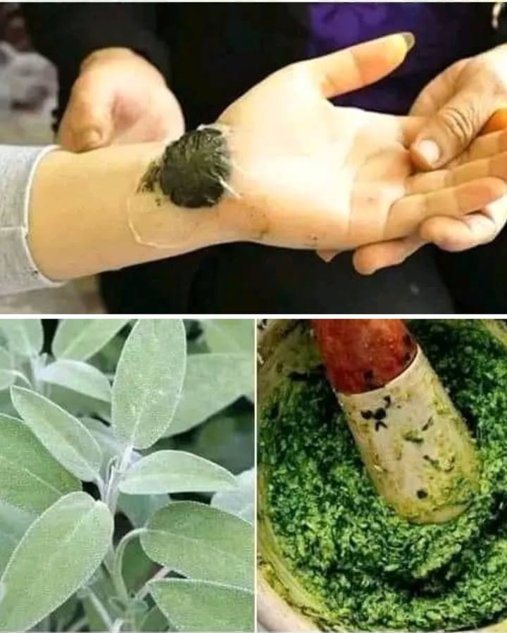 Cataplasme à la Sauge : le secret des anciens contre la douleur 

La sauge nest pas seulement une plante pour le thé ou la cuisine  elle est aussi un véritable trésor pour apaiser les douleurs musculaires et articulaires !

1 Cueillez quelques feuilles fraîches de sauge 
Elles doivent être propres et bien vertes. Pas besoin den prendre trop, une poignée suffit !

2 Écrasez-les dans un mortier 
Ajoutez juste un peu deau chaude pour former une pâte épaisse et parfumée oui, lodeur est forte mais agréable .

3 Appliquez la pâte sur la zone douloureuse 
Déposez le mélange sur un linge propre, puis placez-le sur la peau.

4 Laissez agir 20 à 30 minutes 
La chaleur naturelle de la plante détend les muscles et apaise la tension.

Petit conseil : ne réutilisez pas la même préparation deux fois ! Une version fraîche est toujours plus efficace
