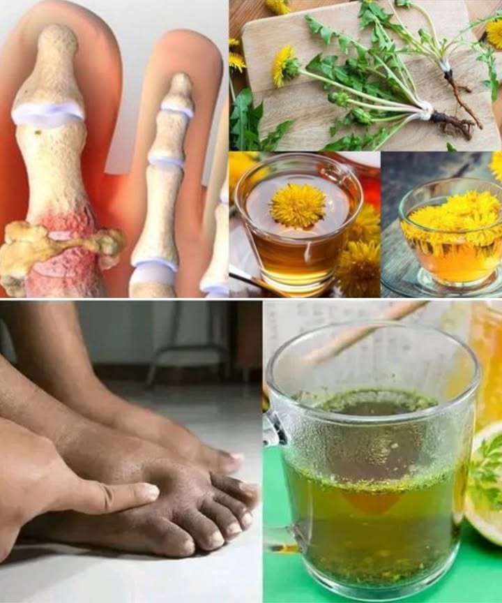 La meilleure tisane pour les jambes gonflées : un remède naturel contre la rétention deau 

Vous souffrez de jambes lourdes ou de chevilles enflées après une longue journée ? La rétention deau et la mauvaise circulation sont souvent les principales causes de ce désagrément. Heureusement, la nature offre une solution douce et efficace : une tisane diurétique et anti-inflammatoire qui aide à éliminer lexcès de liquide, stimuler la circulation et alléger les jambes.

 Recette simple de tisane pour jambes gonflées

Ce mélange à base de plantes favorise lélimination des toxines et soulage la sensation de lourdeur.

Ingrédients :
 1 c. à soupe de feuilles de pissenlit séchées
 1 c. à café de gingembre frais râpé
 1 c. à café de prêle séchée
 1 c. à café de persil frais haché
 500 ml deau
 Jus dun demi-citron facultatif
 Miel au goût facultatif

Préparation :
1 Faites bouillir leau dans une casserole.
2 Ajoutez le pissenlit, le gingembre, la prêle et le persil.
3 Laissez mijoter à feu doux pendant 10 minutes.
4 Retirez du feu et laissez infuser 5 minutes supplémentaires.
5 Filtrez et dégustez, avec un peu de citron et de miel si vous le souhaitez.

 Comment la consommer pour de meilleurs résultats

Buvez une tasse à jeun le matin et une autre laprès-midi.

Faites une cure de 7 jours, puis observez 3 jours de pause avant de recommencer.

Associez cette tisane à une alimentation équilibrée et une bonne hydratation.

 Pourquoi ça marche  Bienfaits principaux

1 Réduit la rétention deau  Aide le corps à éliminer naturellement lexcès de liquide.
2 Améliore la circulation  Allège les jambes et réduit la sensation de lourdeur.
3 Détoxifie lorganisme  Soutient les reins et le foie dans leur rôle purifiant.
4 Calme linflammation  Apaise les tissus gonflés et sensibles.
5 Régule la tension artérielle  Contribue à un système circulatoire sain.
6 Facilite la digestion  Réduit les ballonnements et stimule le transit.
7 Renforce limmunité  Riche en antioxydants, protège le corps du stress oxydatif.
8 Lutte contre la fatigue  Rend les jambes plus légères et redonne de lénergie.

 Les ingrédients vedettes

 Pissenlit  Diurétique naturel, stimule les reins et aide à drainer lexcès deau.
 Gingembre  Favorise la circulation et combat linflammation.
 Prêle  Riche en minéraux, renforce les vaisseaux sanguins et soutient la détox.
 Persil  Antioxydant puissant, aide à réduire les gonflements et à purifier lorganisme.
 Citron  Alcalinise le corps, stimule la digestion et renforce limmunité.
 Miel  Apaise, adoucit et apporte une touche sucrée naturelle.

 Précautions

Ne pas en abuser : trop de tisane diurétique peut provoquer une déshydratation.

Femmes enceintes ou allaitantes : demandez conseil à un professionnel de santé.

Si vous prenez un traitement pour les reins ou la tension, consultez votre médecin.

En cas de calculs rénaux ou de troubles digestifs sévères, évitez cette préparation.

 En résumé

Les jambes gonflées ne sont pas une fatalité ! Grâce à cette tisane naturelle à base de pissenlit, gingembre, prêle et persil, vous pouvez aider votre corps à drainer leau retenue, réactiver la circulation, et retrouver légèreté et confort.