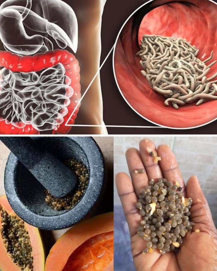 Graines de Papaye : le remède naturel contre les parasites 

Ces petites graines noires souvent jetées à la poubelle sont en réalité un trésor pour ton système digestif ! Elles ont des propriétés antiparasitaires puissantes et aident à nettoyer les intestins naturellement.

省 1 Cueille des graines bien mûres
Prends une papaye mûre, coupe-la et récupère les graines. Rince-les pour enlever la pulpe et fais-les sécher quelques heures.

華 2 Écrase-les doucement
Utilise un mortier pour les broyer légèrement. Pas besoin den faire une poudre fine  juste assez pour activer leurs enzymes naturelles.

籠 3 Consomme-les avec du miel
Avaler ces graines seules, cest une erreur quon fait tous au début  ! Leur goût est amer. Mélange-les plutôt avec une cuillère de miel, matin et soir pendant quelques jours.

 4 Bois beaucoup deau
Les graines agissent comme un petit balai interne, donc lhydratation est essentielle pour aider ton corps à éliminer les toxines.

 Petit rappel : elles ne remplacent pas un traitement médical si tu soupçonnes une infection grave.

Tu connaissais déjà ce secret de grand-mère ou tu jetais toujours les graines ?