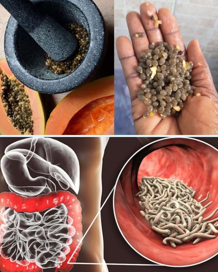 Les Graines de Papaye et Votre Intestin : Petite Astuce Naturelle 

1 Graines à croquer
Les graines de papaye sont parfois oubliées et finissent direct à la poubelle. Erreur classique ! Elles peuvent aider la digestion et apporter un petit coup de ménage naturel à lintestin.

2 À écraser ou à avaler
On peut les écraser pour les ajouter à un yaourt, ou les avaler telles quelles si on aime les goûts un peu forts. Et oui parfois on fait la grimace, mais ça passe vite 

3 Astuce anti-invités indésirables
Elles sont souvent utilisées dans les remèdes maison pour aider à réduire les parasites intestinaux. Rien de magique, mais un petit geste naturel que beaucoup apprécient.

4 Commencer doucement
Pas besoin den prendre une poignée ! Quelques-unes suffisent. Sinon bon courage pour lestomac, on a tous déjà voulu aller trop vite.

5 Et surtout régularité
Une petite prise de temps en temps, cest mieux que dattendre davoir le ventre qui fait des siennes avant dy penser.

 Conclusion
Simple, naturel et facile à tester. Les graines de papaye peuvent devenir un allié sympa pour votre digestion à condition de ne pas tout mâcher dun coup comme un champion !