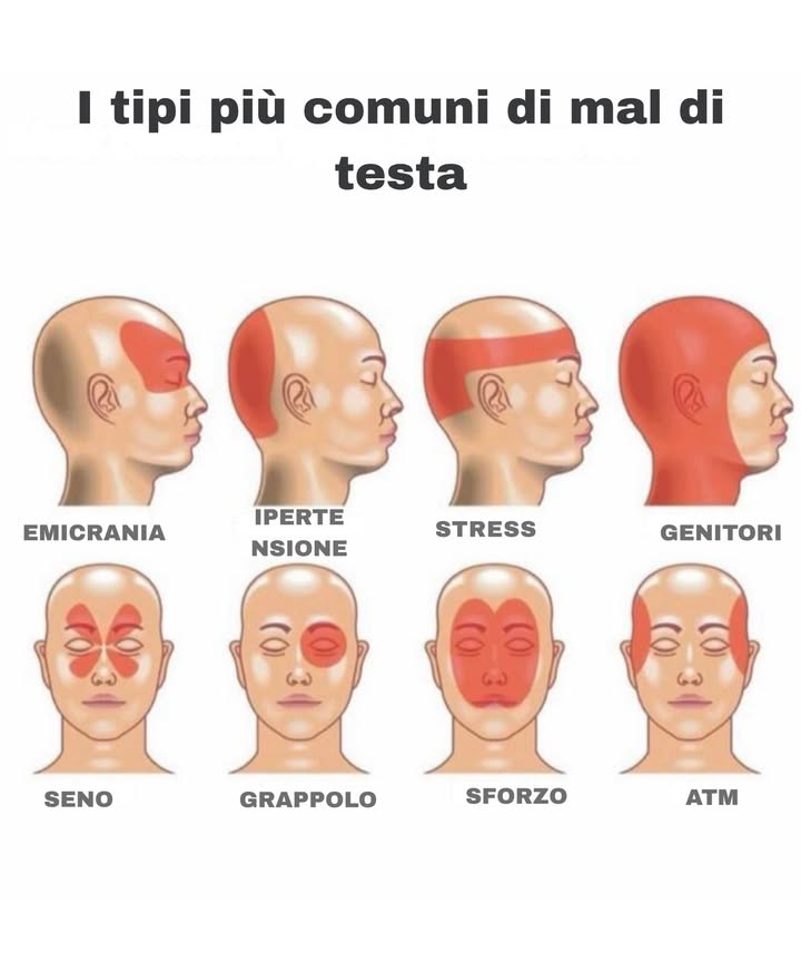 勞 Tipi Comuni di Mal di Testa e Dove Colpiscono

 Emicrania

Dove: Un lato, dietro occhio/tempia

Tipo: Pulsante, intenso

Segni: Nausea, luce/suoni fastidiosi

 Da Ipertensione

Dove: Parte posteriore

Tipo: Sordo, pulsante

Nota: Peggiora al mattino

 Da Stress Tensione

Dove: Fronte, tempie, a fascia

Tipo: Pressione costante

 Parental

Dove: Tutta la testa

Tipo: Sordo, da fatica

Causa: Stress, poco sonno

蠟 Sinusale

Dove: Fronte, occhi, guance

Tipo: Pressione

Segni: Congestione, febbre

 A Grappolo

Dove: Dietro un occhio

Tipo: Lancinante

Segni: Lacrime, palpebra cadente

 Da Sforzo

Dove: Tutta la testa

Tipo: Improvviso dopo attività

 TMJ Articolazione Mandibolare

Dove: Tempie, mascella, orecchie

Tipo: Dolore con clic o tensione

 Consulta il medico se il dolore è:
 Improvviso e forte
 Con vista offuscata o intorpidimento
 Persistente o peggiora