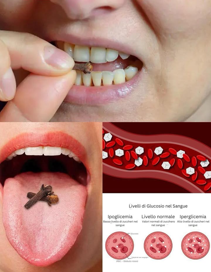 Masticare 2 chiodi di garofano al giorno potrebbe salvarti la vita, ma la maggior parte delle persone non lo sa… 
 8 Benefici Sorprendenti dellAcqua ai Chiodi di Garofano 

I chiodi di garofano sono noti per il loro aroma intenso e le proprietà medicinali, ma lasciarli in infusione in acqua ne amplifica i benefici. Lacqua ai chiodi di garofano, ottenuta mettendo in ammollo 23 chiodi per una notte, è ricca di antiossidanti, sostanze antinfiammatorie e nutrienti essenziali che sostengono il benessere quotidiano.

 1. Favorisce la digestione
Stimola la produzione di enzimi digestivi, allevia gonfiore, gas e indigestione. Bere un bicchiere al mattino a stomaco vuoto aiuta a riequilibrare lapparato digerente.

醴 2. Migliora la salute orale
Grazie alle proprietà antibatteriche, lacqua ai chiodi di garofano combatte lalito cattivo, calma le gengive irritate e aiuta a prevenire infiammazioni. Può essere usata anche come collutorio naturale.

 3. Rafforza il sistema immunitario
Gli antiossidanti presenti proteggono dalle infezioni e riducono lo stress ossidativo, rafforzando le difese dellorganismo in modo naturale.

 4. Allevia disturbi respiratori
Leffetto espettorante e lenitivo aiuta in caso di tosse, raffreddore o gola irritata. Bere linfuso tiepido dona sollievo e libera le vie respiratorie.

 5. Migliora la salute della pelle
Le proprietà antibatteriche e antifungine aiutano a contrastare acne e impurità. Può essere bevuta o applicata diluita sul viso per una pelle più chiara e purificata.

 6. Regola la glicemia
I composti dei chiodi di garofano favoriscono la funzione dellinsulina e aiutano a stabilizzare i livelli di zucchero nel sangue.

例 7. Riduce dolori articolari e infiammazioni
Grazie alleugenolo, potente antinfiammatorio naturale, lacqua ai chiodi di garofano può alleviare dolori e rigidità articolare, migliorando la mobilità.

 8. Supporta il controllo del peso
Accelera il metabolismo e riduce la fame nervosa, favorendo una sensazione di sazietà se bevuta prima dei pasti.

 Come prepararla
Metti 23 chiodi di garofano in un bicchiere dacqua e lascia in infusione tutta la notte. Filtra e bevi al mattino a stomaco vuoto. Per un effetto più intenso, fai bollire i chiodi per qualche minuto, lascia raffreddare e consuma linfuso.

Un rimedio semplice, economico e naturale che sostiene la digestione, rafforza il sistema immunitario e dona energia al corpo ogni giorno.