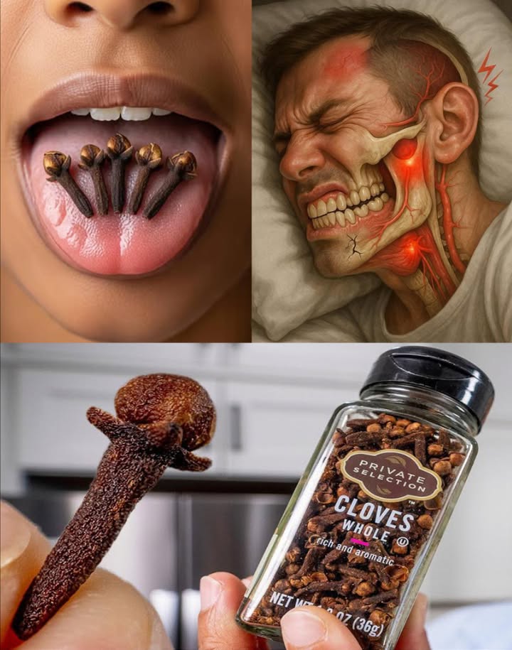 Tutti amano i chiodi di garofano, ma la maggior parte delle persone non sa che tenerli in bocca è un rimedio naturale per alleviare il mal di denti.
Chiodi di Garofano in Bocca 
Un rimedio naturale per alleviare il mal di denti in modo rapido e sicuro

Da secoli, i chiodi di garofano sono considerati uno dei rimedi naturali più efficaci contro il dolore dentale. Questa piccola spezia profumata, presente in quasi ogni cucina, nasconde un potere terapeutico straordinario grazie alleugenolo, un composto naturale dalle proprietà antidolorifiche, antibatteriche e antinfiammatorie.

 Perché Funziona

Leugenolo agisce come un leggero anestetico naturale, penetrando nei tessuti intorno al dente dolorante e riducendo il dolore in pochi minuti.
Inoltre, combatte i batteri e aiuta a calmare le infiammazioni gengivali o piccole infezioni orali.

覆 Come Usare i Chiodi di Garofano Interi

1 Prendi 25 chiodi di garofano interi, duri e integri.
2 Posizionali vicino al dente dolorante tra guancia e gengiva.
3 Succhiali lentamente per liberare lolio essenziale naturale.
4 Quando si ammorbidiscono, masticali leggermente per rilasciare più eugenolo.
5 Tienili in bocca per 1015 minuti, poi sputali e sciacqua con acqua tiepida.
 Puoi ripetere 23 volte al giorno, secondo necessità.

 Olio di Garofano Fai-da-Te

Ingredienti:
 2 cucchiai di olio doliva o di cocco
 1 cucchiaino di chiodi di garofano macinati o 45 pestati

Preparazione:
Mescola tutto in un piccolo barattolo di vetro, lascia riposare 24 ore e filtra.
Imbevi un batuffolo di cotone e applicalo sul dente o sulla gengiva per 510 minuti.
Risciacqua la bocca con acqua tiepida.
 Si conserva per settimane in un contenitore chiuso.

 Altri Benefici Orali dei Chiodi di Garofano

 Combattono lalito cattivo eliminando i batteri.
 Riducano linfiammazione gengivale.
 Aiutano a prevenire la carie.
 Leniscono gengive doloranti e piccole afte.
 Migliorano ligiene orale naturale se aggiunti a dentifricio o collutorio.

 Precauzioni

 Non ingerire chiodi interi o olio puro.
 Evita luso di olio essenziale non diluito: può irritare le mucose.
 Bambini e donne in gravidanza dovrebbero usarli solo su consiglio medico.
 Se il dolore persiste oltre un giorno, o è accompagnato da gonfiore o febbre, consulta subito il dentista.

 La Natura è la miglior farmacia.
Un semplice chiodo di garofano può offrire sollievo immediato e naturale dal mal di denti, senza farmaci o sostanze chimiche.
Usalo come primo soccorso naturale, ma ricorda: solo un professionista può risolvere la causa del dolore in modo definitivo.
