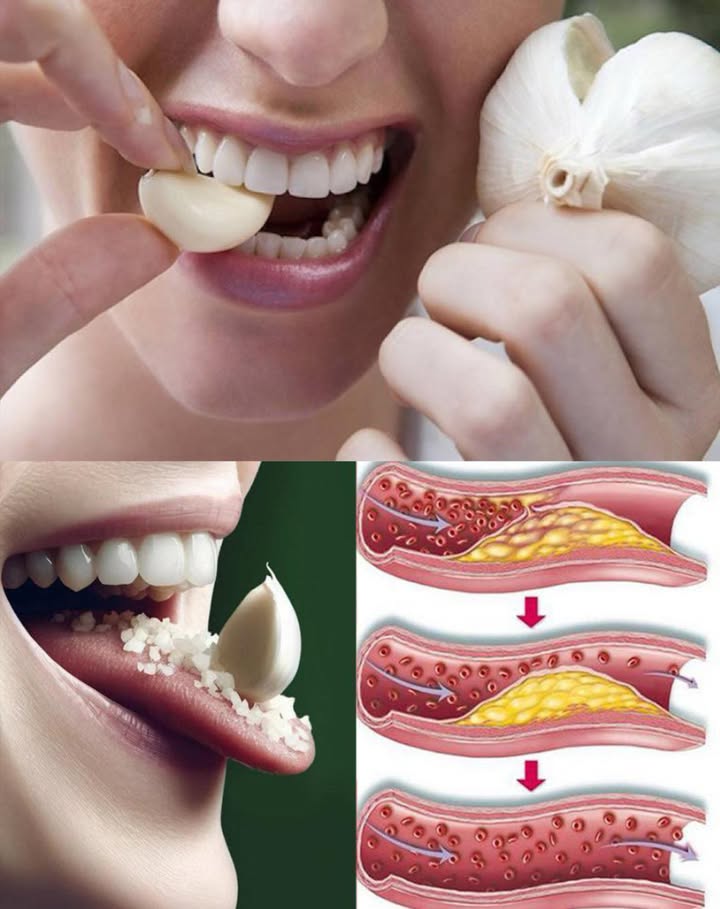 Mangiare uno spicchio daglio crudo al giorno tiene lontano il medico e probabilmente ti salva anche la vita…
 Benefici dellAglio Crudo per il Cuore

喝 Riduce il colesterolo cattivo LDL grazie ai composti solforati.

 Aumenta il colesterolo buono HDL, proteggendo il cuore.

 Abbassa la pressione dilatando i vasi sanguigni.

 Mantiene le arterie elastiche e previene laterosclerosi.

 Migliora la circolazione e lapporto di ossigeno ai tessuti.

 Come Consumarlo

 Taglialo e lascialo riposare 10 minuti per attivare lallicina.

 Ingeriscilo a pezzetti con acqua, come una pillola naturale.

 Mescolalo con miele per gusto e benefici extra.

綾 Aggiungilo crudo a insalate, toast o avocado.

 Prepara acqua allaglio con infusione tiepida e limone.

 Consigli Rapidi

 Inizia con poco: mezzo spicchio al giorno se sei principiante.

 Meglio a digiuno per potenziarne gli effetti.

 Sii costante: i benefici arrivano con luso regolare.

 Chiedi consiglio al medico se assumi anticoagulanti.

 Laglio crudo è un rimedio semplice e naturale per sostenere cuore e circolazione, se introdotto con gradualità e accompagnato da uno stile di vita sano.