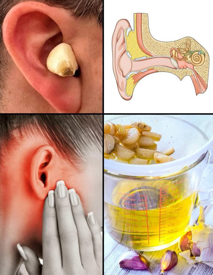 La maggior parte delle persone non sa nemmeno come usare laglio per salvare ludito…
 Aglio per le orecchie 
Un rimedio naturale grazie allallicina, con effetti antibatterici, antivirali e antinfiammatori.
 5 benefici:
裂 Combatte otiti lievi
 Riduce dolore e infiammazione
識 Ammorbidisce il cerume
 Contrasta funghi e prurito
 Mantiene ligiene auricolare
 Come usarlo
Olio allaglio: 12 gocce tiepide nellorecchio
Impacco caldo: spicchio in garza, appoggiato per 1015 min
 Precauzioni: non usare con timpano perforato, non inserire spicchi nel condotto, olio sempre tiepido, chiedere consiglio medico se i sintomi persistono.
 Laglio: non solo in cucina, ma anche un alleato naturale per la salute delle orecchie!