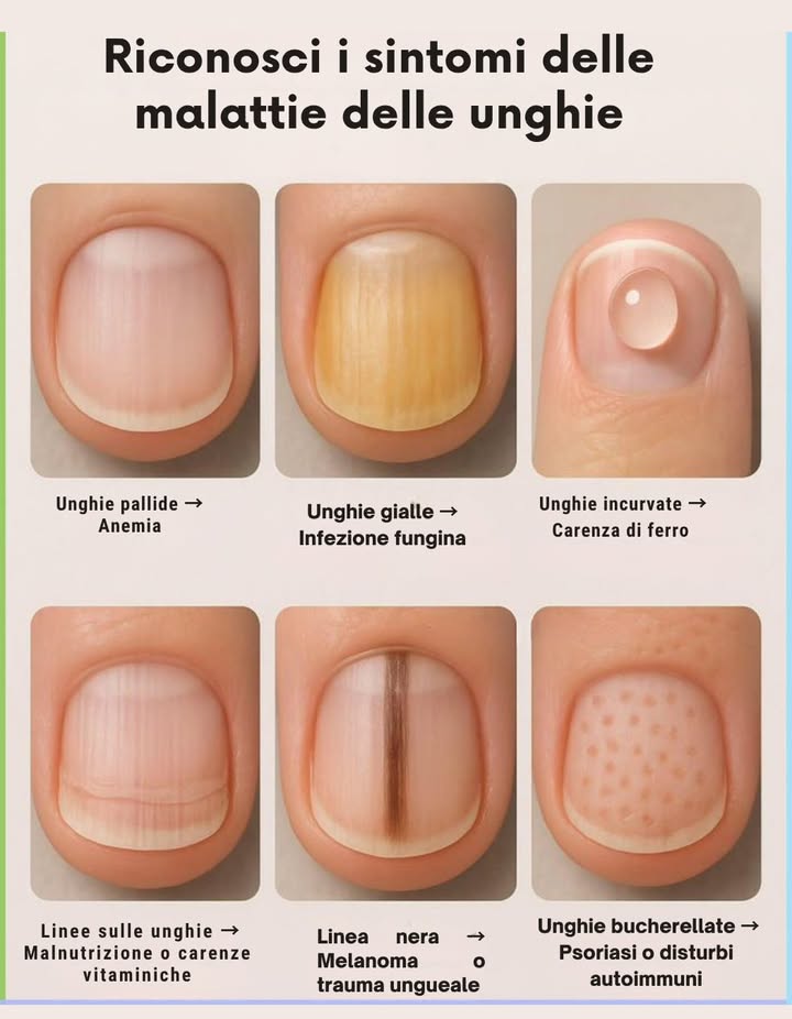 Riconosci i sintomi delle malattie delle unghie 

 Unghie pallide  possono indicare anemia o scarsa ossigenazione del sangue.

 Unghie gialle  spesso dovute a infezione fungina o uso prolungato di smalti aggressivi.

 Linea nera  può segnalare melanoma da controllare subito o un trauma ungueale.

 Unghie incurvate  legate a carenza di ferro o disturbi respiratori cronici.

 Linee sulle unghie  segno di malnutrizione o carenze vitaminiche soprattutto zinco e biotina.

 Unghie bucherellate  associate a psoriasi o disturbi autoimmuni.

 Le unghie raccontano molto sullo stato di salute generale: osservarle regolarmente può aiutare a individuare squilibri precoci.