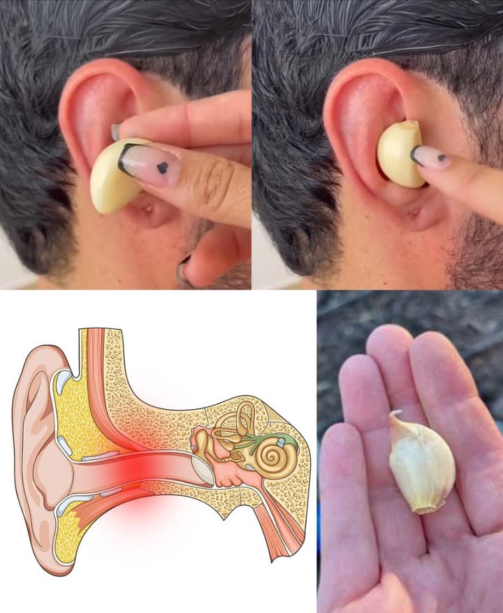 La maggior parte delle persone non sa nemmeno come usare laglio per migliorare ludito… 
龍 Aglio per la Salute delle Orecchie
Sollievo Naturale e Protezione Delicata

Laglio è un rimedio tradizionale usato da secoli per lenire dolori, sostenere ligiene dellorecchio e calmare fastidi lievi. Grazie ai suoi composti antibatterici, antinfiammatori e antifungini, offre un supporto naturale senza ricorrere a prodotti aggressivi.

 Perché lAglio Fa Bene alle Orecchie

Contiene allicina, una molecola capace di combattere batteri, funghi, virus e infiammazioni. Un aiuto naturale nei piccoli disturbi che coinvolgono lorecchio esterno.

龍 5 Benefici dellAglio per lOrecchio
1 Aiuta nelle Infezioni Leggere

Lazione antibatterica può ridurre lintensità delle infezioni lievi dellorecchio esterno o medio.

2 Riduce Infiammazione e Dolore

I composti solforati dellaglio possiedono un effetto decongestionante e calmante, utile nei dolori legati a raffreddori e sinusiti.

3 Ammorbidisce il Cerume

Lolio daglio aiuta a sciogliere il cerume duro, facilitandone la rimozione in modo delicato.

4 Contrasta le Infezioni Fungine

Può aiutare quando il fastidio è causato da una crescita eccessiva di funghi, come Candida.

5 Favorisce lIgiene dellOrecchio

Mantiene il canale auricolare più pulito e meno soggetto a infezioni o accumuli.

龍 Come Usare lAglio in Modo Sicuro per le Orecchie
Metodo 1  Olio dAglio Gocce

Ingredienti:
 12 spicchi daglio
 2 cucchiai di olio doliva o di cocco
 Barattolino pulito
 Colino o garza
 Contagocce facoltativo

Preparazione:

Sbucciare e schiacciare leggermente gli spicchi.

Scaldare lolio a fuoco molto basso.

Aggiungere laglio e lasciarlo sobbollire 510 minuti mai friggere.

Ritirare dal fuoco e lasciar intiepidire.

Filtrare e conservare in vetro pulito.

Uso:
 Quando lolio è tiepido temperatura della pelle, applicare 12 gocce nellorecchio.
 Mantenere la testa inclinata 510 minuti.
 Ripetere 12 volte al giorno per massimo 3 giorni.

Metodo 2  Impacco Caldo allAglio Senza Olio

Ingredienti:
 1 spicchio daglio
 Garza o panno sottile
 Asciugamano caldo

Preparazione:

Schiacciare leggermente lo spicchio.

Avvolgerlo in una garza.

Scaldare limpacco avvicinandolo a un asciugamano caldo.

Posizionarlo vicino allingresso dellorecchio mai dentro.

Tenere 1015 minuti distesi su un fianco.

 Precauzioni Importanti

 Non usare aglio se sospetti timpano perforato fuoriuscita di liquido, dolore acuto, calo uditivo.
 Non inserire mai laglio direttamente nel canale uditivo.
 Lolio deve essere solo tiepido, mai caldo.
 Se i sintomi persistono o peggiorano, consultare un medico.
 Massima attenzione nei bambini e nelle infezioni ricorrenti.

龍 Un Rimedio Antico per un Sollievo Delicato

Laglio è molto più di un ingrediente in cucina: offre un supporto naturale per dolori, infiammazioni e igiene dellorecchio. Usato con cura, può essere un alleato prezioso per il benessere quotidiano.