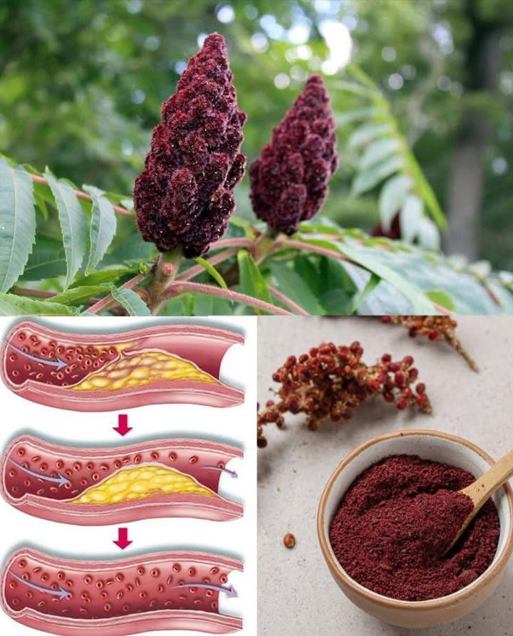 Se vedete questo albero, siete seduti sulloro e non lo sapete nemmeno…
 Benefici straordinari del sommacco  la spezia rossa che cura e insaporisce 

Con il suo gusto acidulo e limonoso, il sommacco non solo arricchisce piatti mediterranei e orientali, ma è anche una miniera di benessere. Ricco di antiossidanti, vitamina C e proprietà antinfiammatorie, è un alleato naturale per corpo e mente. Scopri i suoi 15 benefici principali e come usarlo facilmente ogni giorno:

 15 benefici del sommacco
 Riduce linfiammazione  utile contro dolori articolari e artrite
 Protegge il cuore  abbassa il colesterolo e migliora la circolazione
 Rafforza il sistema immunitario  grazie alla vitamina C
 Migliora la digestione  stimola gli enzimi e riduce gonfiori
 Regola la glicemia  aiuta chi soffre di diabete o insulino-resistenza
 Combatte infezioni  antibatterico e antifungino naturale
 Aiuta a controllare il peso  riduce la fame e stabilizza lo zucchero nel sangue
 Allevia il mal di gola  ottimo in infuso, effetto lenitivo
 Fa bene alla pelle  contrasta i radicali liberi e illumina il viso
 Riduce il rischio di tumori  potente antiossidante cellulare
 Favorisce la respirazione  calma tosse e bronchite
 Aumenta lenergia  sostiene la produzione naturale di vitalità
 Rinforza le ossa  fonte di calcio e minerali essenziali
 Combatte le infezioni urinarie  proprietà antisettiche
 Disintossica il corpo  depura fegato e reni

 Come usare il sommacco per il tuo benessere

綾 Come spezia nei piatti
Spolveralo su insalate, verdure arrosto o carni grigliate per un tocco agrumato e salutare.

 Infuso di sommacco
1 cucchiaino in acqua calda per 10 min  perfetto contro infiammazioni e mal di gola. Aggiungi miele e limone per potenziarne leffetto.

 Acqua detox
Un pizzico nella borraccia o nei frullati per idratazione, energia e disintossicazione quotidiana.

林 Uso topico
Pasta con acqua per acne, rash cutanei o piccole ferite: effetto antisettico naturale.

北 Con yogurt o salse
Mescolato con yogurt crea un dressing sano, digestivo e saziante.

 Integra il sommacco nella tua routine e goditi ogni giorno i suoi effetti curativi. Una spezia, mille benefici.