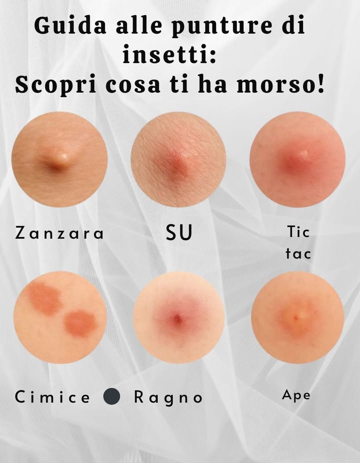 Identifica le Punture: Riconosci i Morsi degli Insetti Più Comuni 烈
Pinterest-style in italiano 

1 Zanzara: Gonfiore rosato che prude. Non grattare!
2 Formica: Piccolo ponfo rosso acceso, con bruciore.  Possibili vesciche.
3 Zecca: Macchia rossa con centro scuro occhio di bue.  Allinizio non fa male, ma attenzione alla febbre!
4 Cimice da letto: Gruppi di bollicine rosse e pruriginose.  Controlla collo e braccia!
5 Ragno: Centro rosso e gonfiore. Doloroso se peggiora, vai dal medico.
6 Puntura dape: Gonfiore con foro visibile. Rimuovi il pungiglione  e controlla reazioni allergiche.

 Consigli utili
 Non grattare!
 Lava con acqua e sapone 識
 Applica antistaminici o crema al cortisone 
 Consulta il medico se hai febbre o difficoltà a respirare