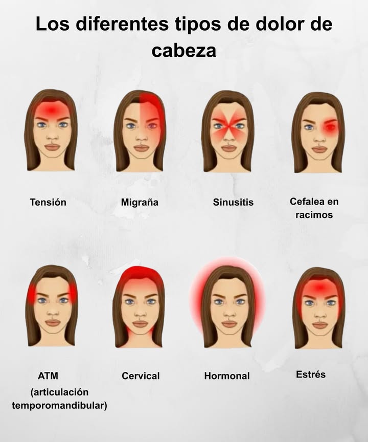 Tipos de dolor de cabeza y sus zonas más comunes 
Conoce las áreas donde suele concentrarse cada tipo de molestia:

 Tensión: presión en la frente o sienes.
 Migraña: dolor intenso en un solo lado.
 Sinusitis: dolor en frente y alrededor de los ojos.
 Cefalea en racimos: punzante detrás de un ojo.
 ATM mandíbula: dolor lateral en sienes.
 Cervical: se extiende desde el cuello hacia arriba.
 Hormonal: sensación de presión general en toda la cabeza.
 Estrés: presión en frente y entrecejo.

 Cuida tu descanso, hidratación y postura para prevenirlos.