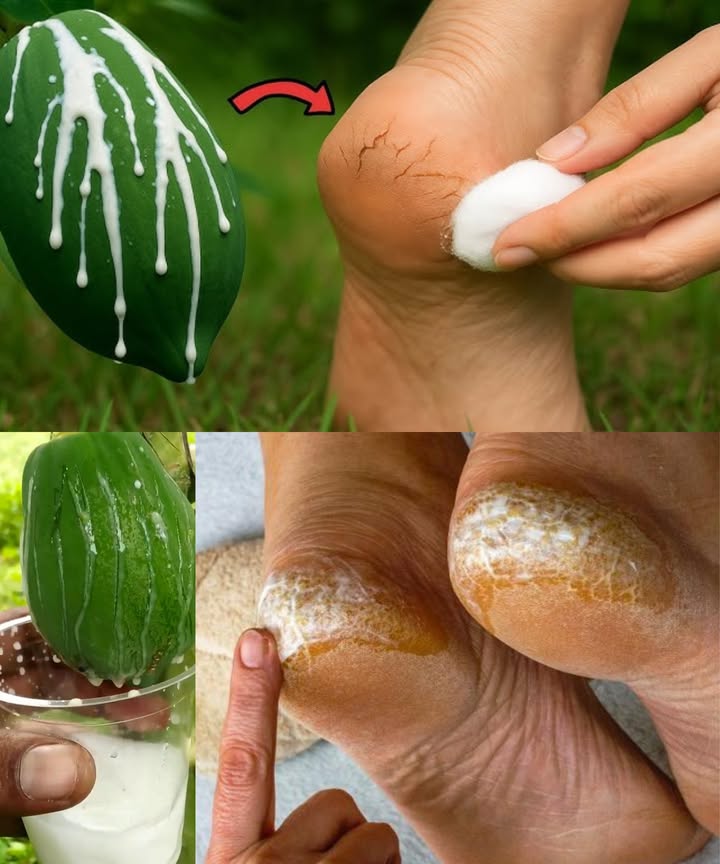 李 Savia de papaya: remedio natural para talones agrietados

 Rica en enzimas naturales, la savia de papaya suaviza, hidrata y regenera la piel.
 Es un tratamiento casero sencillo, económico y eficaz para pies secos y ásperos.

 Cómo obtenerla
 Usa una papaya verde o el tallo de sus hojas.
 Lava bien la superficie y haz un pequeño corte con un cuchillo limpio.
 Recoge la savia blanca y espesa con una cuchara o algodón.
 Utiliza de inmediato o guarda 12 días en refrigeración.

 Cómo aplicarla
 Lava y seca bien los pies.
 Aplica una capa fina de savia sobre las grietas.
 Deja actuar 1520 minutos sin caminar.
 Enjuaga con agua tibia y aplica aceite de coco o manteca de karité.
 Repite 23 veces por semana.

 Beneficios principales
 Elimina células muertas gracias a la papaína.
 Hidrata y suaviza la piel.
 Favorece la regeneración cutánea.
 Protege contra bacterias y hongos.

禮 Consejos extra
 Frota con piedra pómez tras el enjuague si los talones están muy duros.
 Usa calcetines de algodón después de hidratar para mantener la suavidad.
 Hidrátate bien: la sequedad interna también afecta a la piel.

 Precaución
 Haz una prueba en el brazo antes de usarla: puede irritar pieles sensibles.
 No aplicar sobre heridas abiertas o grietas profundas.

 Un cuidado natural y efectivo que devuelve a tus pies su suavidad con la fuerza curativa de la papaya.
