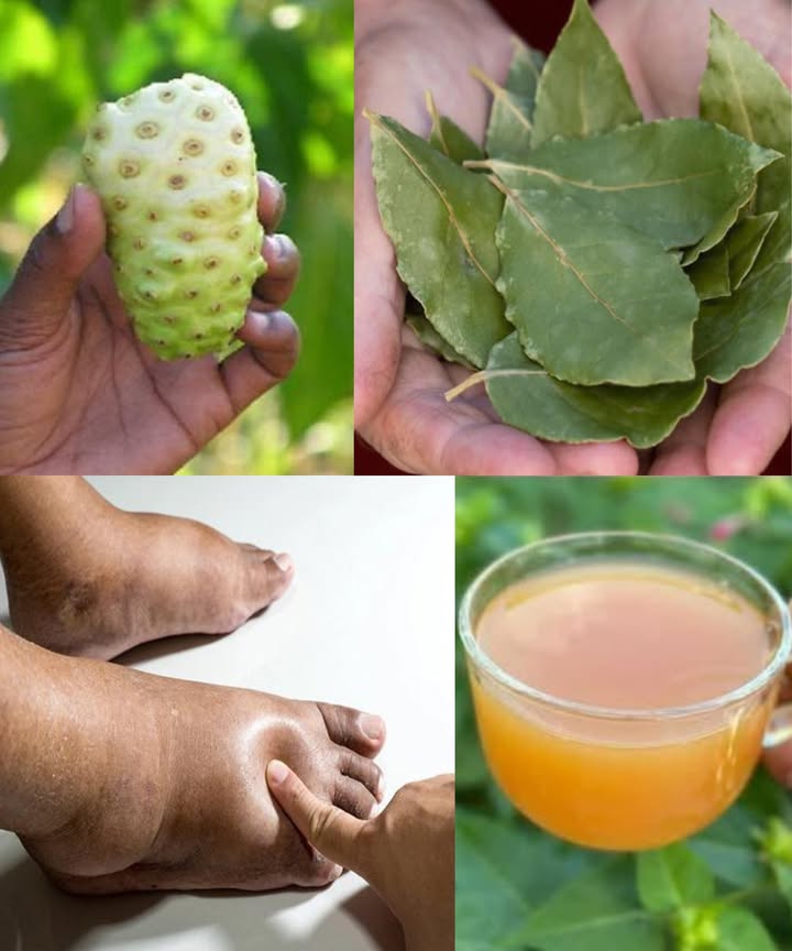 El tónico curativo definitivo 
Una bebida natural poderosa para aliviar pies hinchados, equilibrar el azúcar en sangre y mejorar la circulación.
Con el poder del noni, laurel, hojas de guayaba y cúrcuma, este tónico es un regalo directo de la naturaleza para revitalizar cuerpo y mente.

 Ingredientes naturales:
 3 frutas de noni picadas
 6 hojas de laurel
 8 hojas de guayaba
 3 tazas de agua
  cdta de cúrcuma en polvo

六 Preparación:
1 Lava bien todos los ingredientes.
2 Corta el noni en trozos pequeños.
3 Hierve las 3 tazas de agua.
4 Agrega noni, laurel, guayaba y cúrcuma.
5 Cocina a fuego lento 1520 min.
6 Cuela y bebe caliente o frío.

 Poder de cada ingrediente:
 Noni: antioxidante, regula el azúcar, combate la inflamación.
 Laurel: mejora la circulación y equilibra la glucosa.
 Guayaba: favorece la digestión y la salud del corazón.
 Cúrcuma: antiinflamatoria y fortalecedora de las articulaciones.

 Cómo tomarlo:
Bebe 1 taza en ayunas durante 23 semanas.
Guarda el resto en la nevera hasta 3 días.

 Un gesto diario de autocuidado natural:
Apoya tu bienestar, estimula la circulación y dale a tu cuerpo un descanso sanador desde adentro.