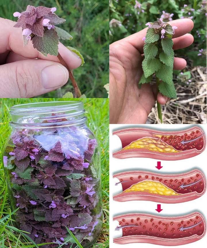 Ortiga muerta morada Lamium purpureum: una joya silvestre de poder medicinal y práctico

La ortiga muerta morada, con sus hojas de tono púrpura y flores delicadas, es una planta humilde que esconde una enorme riqueza natural. Perteneciente a la familia de la menta, crece libremente en jardines, campos y caminos, ofreciendo beneficios para el cuerpo, la mente y el entorno.

 30 beneficios naturales de la ortiga muerta morada
1 Favorece la salud del hígado.
2 Mejora la circulación y el corazón.
3 Alivia quemaduras y quemaduras solares.
4 Reduce la inflamación.
5 Rica en fibra para una digestión saludable.
6 Apoya la función renal.
7 Calma los dolores de cabeza.
8 Favorece un sueño reparador.
9 Ideal en ensaladas, sopas o batidos.
 Refuerza la inmunidad.
11 Fuente de vitamina C, hierro y flavonoides.
12 Atrae abejas y polinizadores.
13 Estimula el crecimiento del cabello.
14 Alivia cólicos menstruales.
15 Calma molestias articulares.
16 Suaviza el dolor de garganta.
17 Funciona como fertilizante natural.
18 Combate la fatiga y aumenta la energía.
19 Ayuda a reducir la fiebre.
20 Mejora la piel y combate erupciones.
21 Favorece la digestión y reduce la hinchazón.
22 Tiene efecto diurético.
23 Actúa como antimicrobiano natural.
24 Reduce síntomas de alergia estacional.
25 Mejora la respiración y alivia la congestión.
26 Actúa como antihistamínico natural.
27 Favorece la cicatrización de heridas.
28 Disminuye el estrés y promueve la calma.
29 Beneficia la salud ocular.
30 Ayuda a controlar el peso.

 Usos caseros sencillos
 Té herbal: seca las hojas y prepara una infusión relajante y nutritiva.
 Cataplasma: machaca hojas frescas y aplica sobre heridas, quemaduras o zonas inflamadas.
 Aceite infundido: mezcla hojas con aceite vegetal y deja reposar para usarlo en la piel.
綾 Ensaladas: añade hojas tiernas frescas a tus platos.
 Compost: incorpora la planta a tu compost para enriquecerlo con nutrientes.

 Preparación básica
 Cosecha: recolecta hojas, flores y tallos de zonas limpias.
 Secado: deja secar al aire en un lugar sombreado.
 Almacenamiento: guarda en frascos herméticos, lejos de la luz.
 Uso: prepara té, cataplasmas o úsala como ingrediente natural.

 Identificación segura
 Hojas en forma de corazón con tinte púrpura.
 Flores pequeñas, rosadas o moradas.
 Tallo cuadrado, típico de la familia de la menta.
 Hojas suaves, sin picor.

 Consejo esencial: antes de recolectar, confirma su identidad con un experto local, ya que puede confundirse con especies similares.

 Una planta humilde, un remedio poderoso:
La ortiga muerta morada es un tesoro botánico lleno de beneficios curativos, ecológicos y culinarios. Perfecta para quienes buscan un estilo de vida natural y equilibrado.
