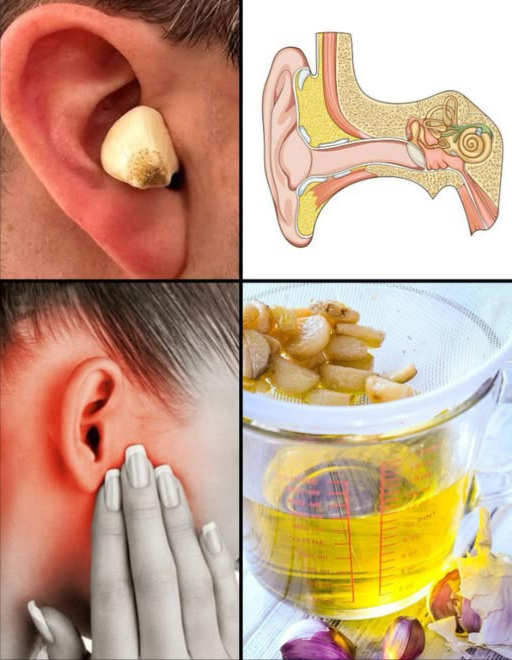 Ail pour les oreilles 
Remède naturel grâce à lallicine, aux propriétés antibactériennes, antivirales et anti-inflammatoires.

 5 bienfaits :
裂 Combat les otites légères
 Soulage la douleur et linflammation
識 Assouplit le cérumen
 Lutte contre les champignons et les démangeaisons
 Maintient une bonne hygiène auriculaire

 Utilisation :
 Huile dail : 1 à 2 gouttes tièdes dans loreille
 Cataplasme chaud : une gousse enveloppée dans une gaze, posée 10 à 15 minutes

 Précautions :
Ne pas utiliser en cas de tympan perforé.
Ne jamais insérer directement une gousse dans le conduit auditif.
Toujours appliquer lhuile tiède.
Consulter un médecin si les symptômes persistent.

 Lail nest pas quun aliment, cest aussi un allié naturel pour la santé des oreilles.