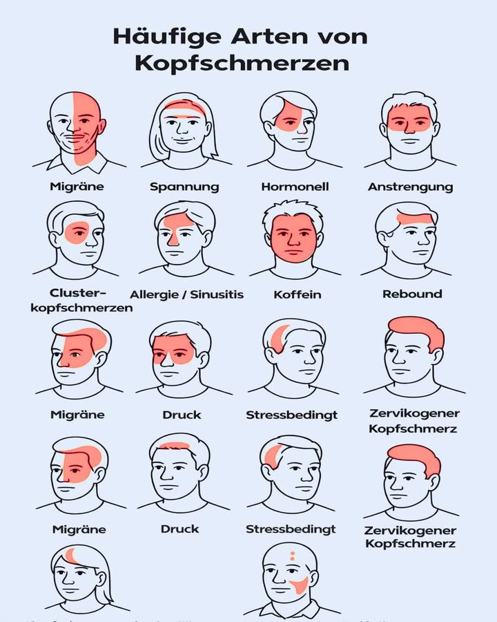 洛 Kopfschmerzen sind nicht alle gleich!

Wusstest du, dass es verschiedene Arten von Kopfschmerzen gibt  und dass der Ort des Schmerzes oft Hinweise auf die Ursache liefert?

 Häufige Arten von Kopfschmerzen:

 Migräne
Oft einseitig, pulsierend, begleitet von Übelkeit oder Lichtempfindlichkeit.

 Spannungskopfschmerzen
Druck oder Engegefühl, meist beidseitig  häufig durch Stress oder Verspannungen.

 Hormonell bedingte Kopfschmerzen
Treten oft im Zusammenhang mit hormonellen Veränderungen auf.

 Belastungs- oder Anstrengungskopfschmerzen
Nach intensiver körperlicher Aktivität.

 Clusterkopfschmerzen
Sehr starke Schmerzen, meist um ein Auge herum.

 Allergie- / Sinusitis-Kopfschmerzen
Druckgefühl im Stirn- oder Nasenbereich.

 Koffein-Kopfschmerzen
Durch zu viel oder plötzlichen Entzug von Koffein.

 Rebound-Kopfschmerzen
Verursacht durch häufige Einnahme von Schmerzmitteln.

 Stressbedingte Kopfschmerzen
Häufig verbunden mit mentaler oder emotionaler Belastung.

 Zervikogener Kopfschmerz
Ausgehend von Nacken- und Wirbelsäulenproblemen.

 Wichtig:
Wenn Kopfschmerzen häufig, sehr stark oder neu auftreten, sollte immer ärztlicher Rat eingeholt werden.
